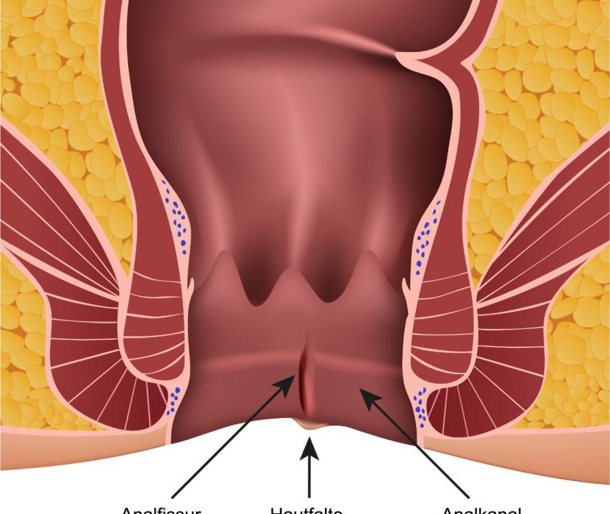 Anal Fissür (Makat Çatlağı) Nedir? Belirtileri ve Tedavi Yöntemleri