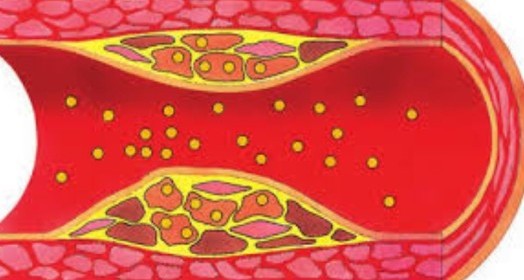 Hiperlipidemi Hastalarında Bariatrik Cerrahinin Klinik Yansımaları
