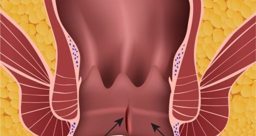 Anal Fissür (Makat Çatlağı) Nedir? Belirtileri ve Tedavi Yöntemleri