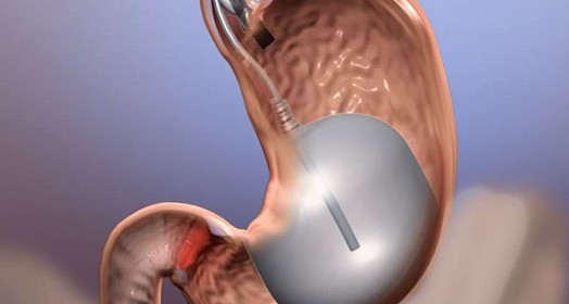 Allurion Mide Balonu Nedir? Ameliyatsız Kilo Vermede Yeni Nesil Yaklaşım