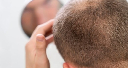 Obezite Cerrahisi Sonrası Saç Dökülmesi Nedir?