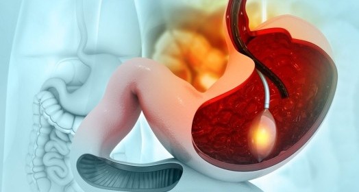Mide Balonu Nedir? 2026 Rehberi ile Zayıflama Yolculuğuna Başlayın