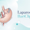 Laparoskopik Bariclip