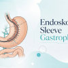 Endoskopik Sleeve Gastroplasti