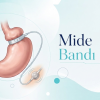 Mide Bandı