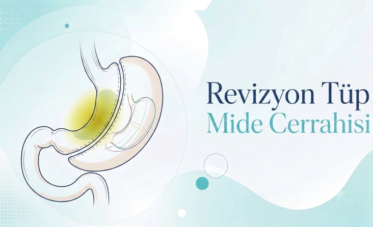 Revizyon Tüp Mide Cerrahisi
