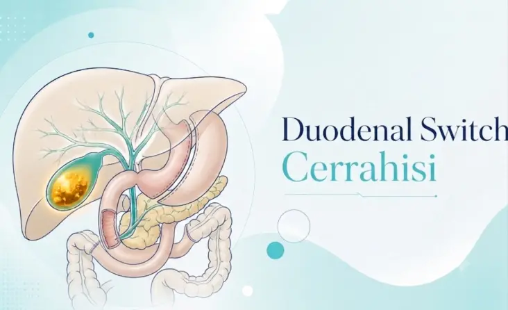 Duodenal Switch tedavisi