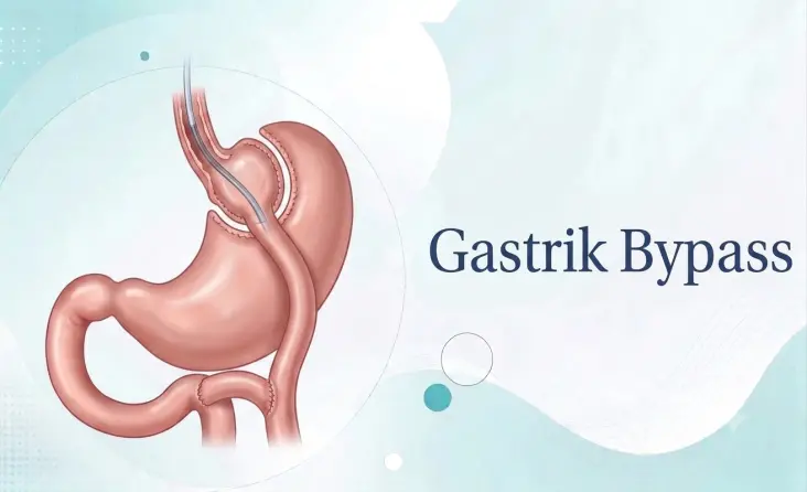 Gastrik Bypass tedavisi