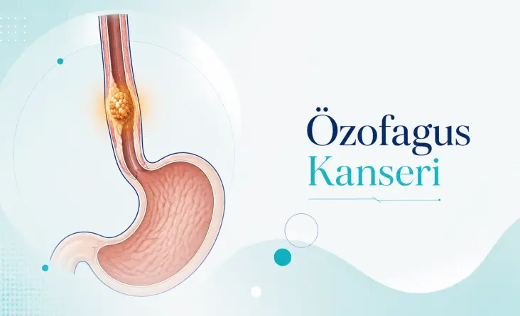 Özofagus Kanseri tedavisi