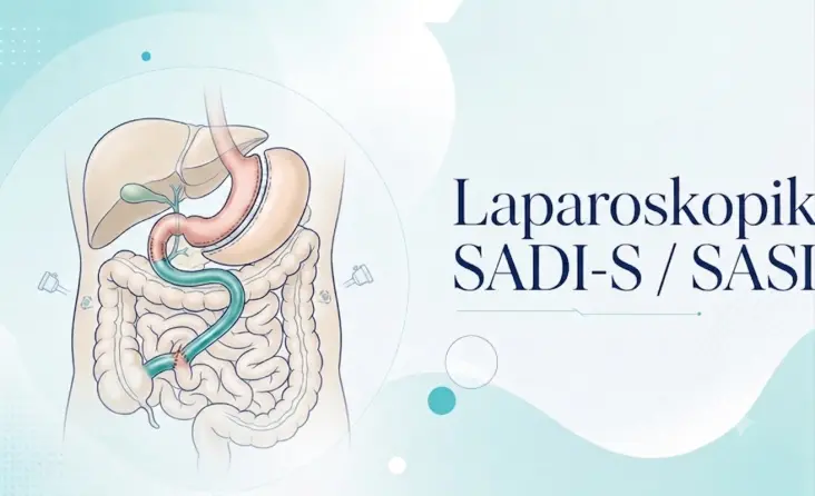 Laparoskopik SADI SASI tedavisi