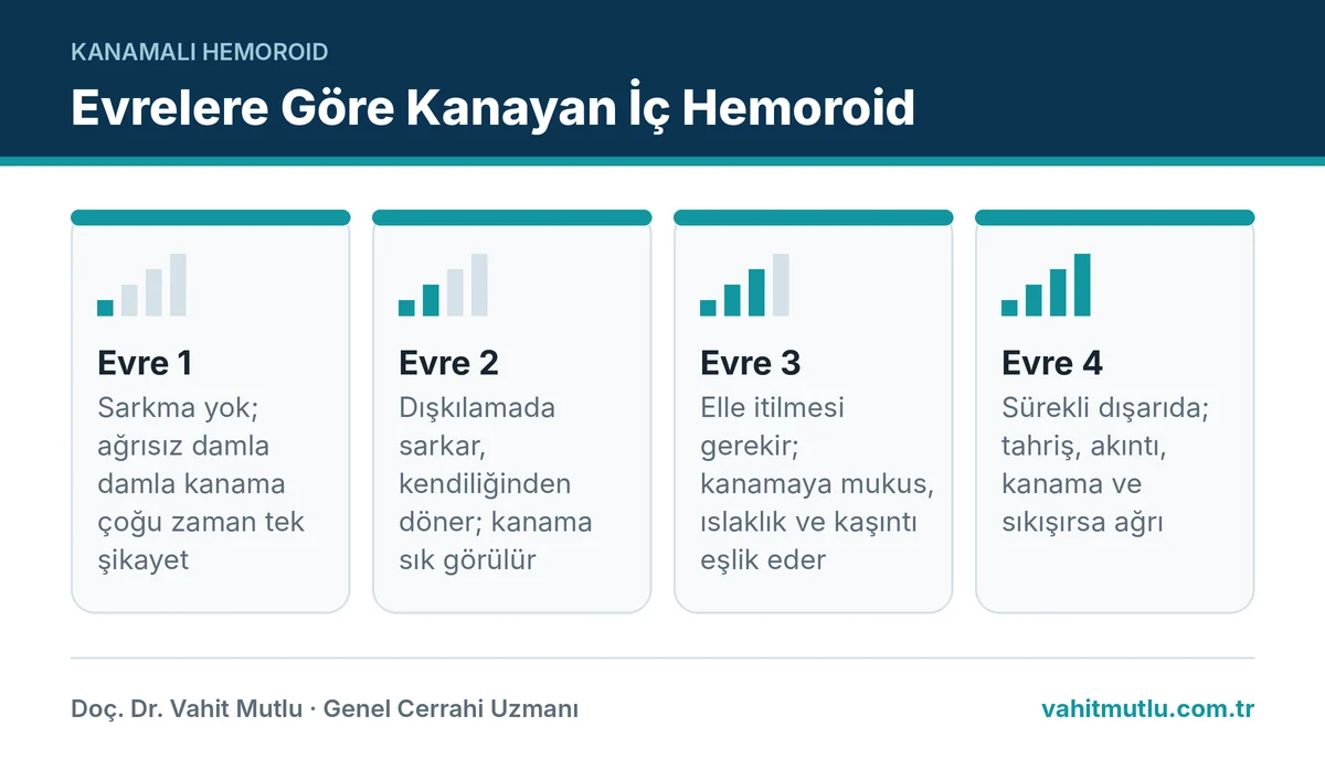 Kanayan iç hemoroidin evre 1'den evre 4'e sarkma durumu ve kanamanın tipik özelliklerini gösteren evre şeması