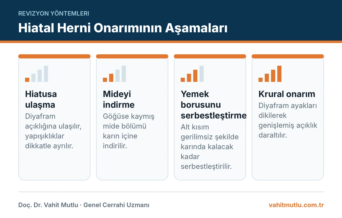 Revizyonda hiatal herni onarımının dört temel aşamasını gösteren infografik
