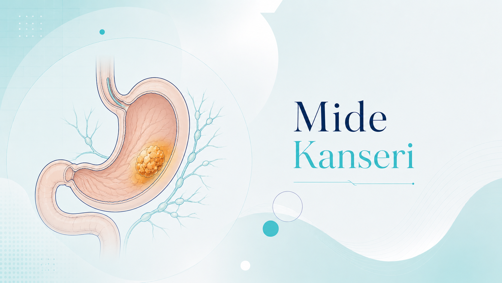 Mide Kanseri