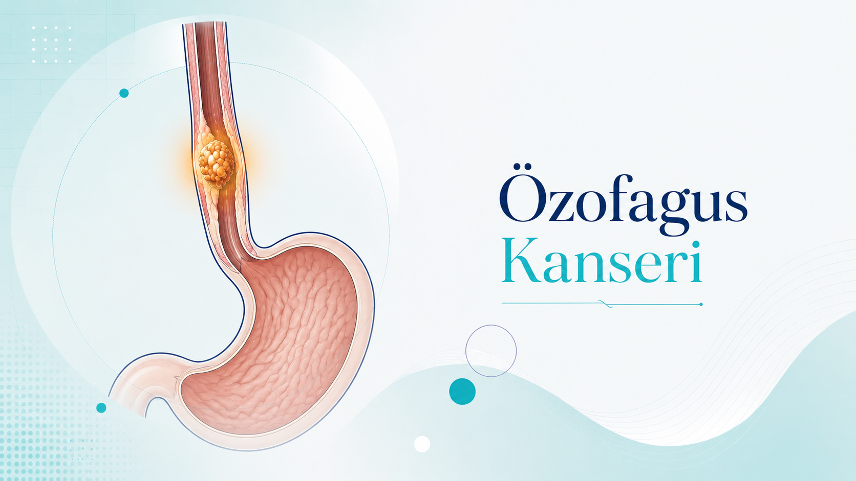 Özofagus Kanseri — Doç. Dr. Vahit Mutlu